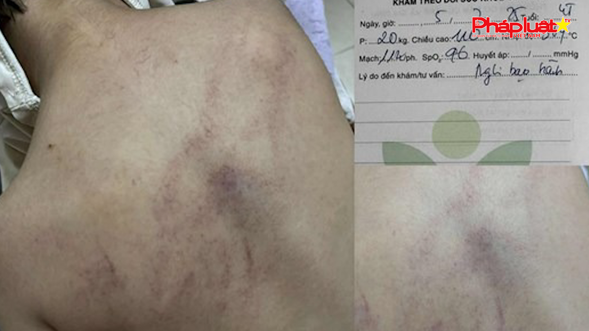 Bản tin Pháp luật & Cộng đồng mạng (ngày 11/7/2025): Cơ quan chức năng vào cuộc vụ bé gái 4 tuổi bị giáo viên mầm non đánh đập, kéo lê, ném vào tường

