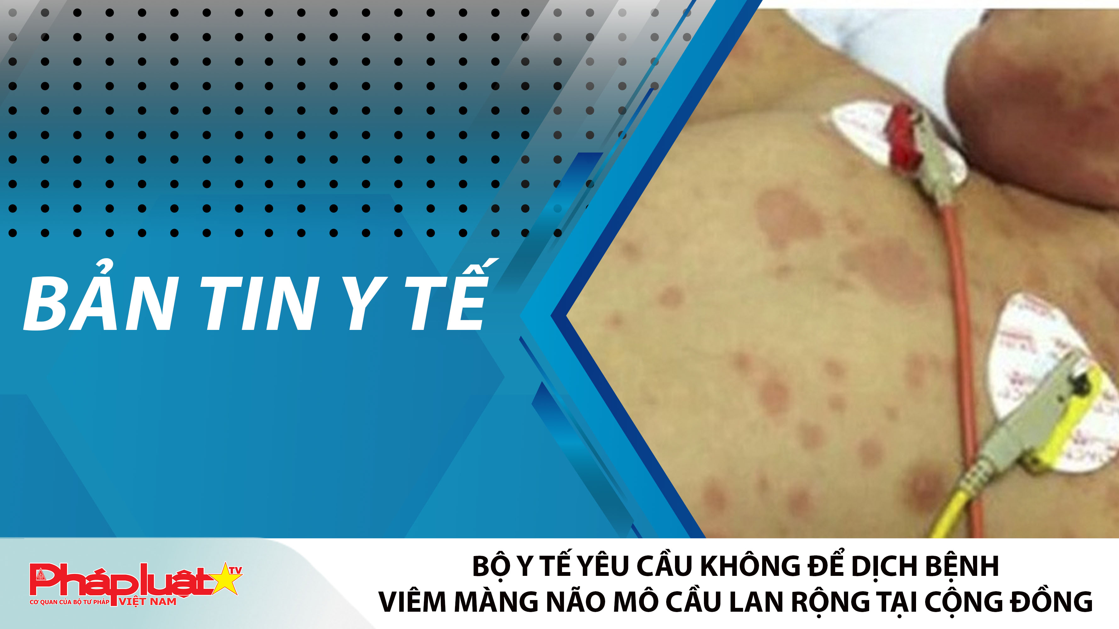 Bản tin Y tế (ngày 24/03/2026): Bộ Y tế yêu cầu không để dịch bệnh viêm màng não mô cầu lan rộng tại cộng đồng